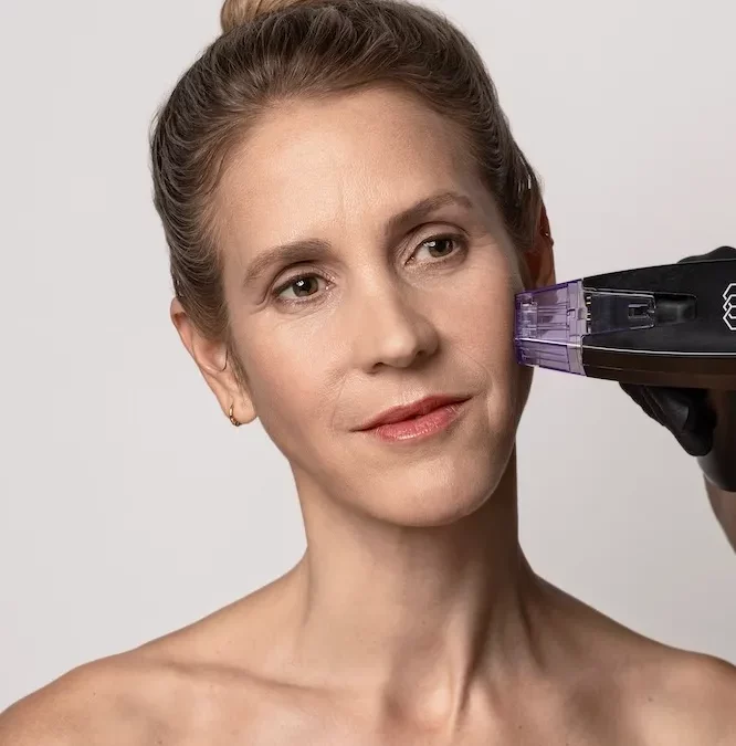 RF MICRONEEDLING